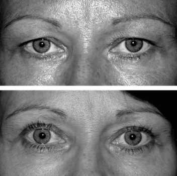Blepharoplastie bovenoogleden