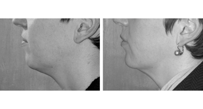 Mentoplastie