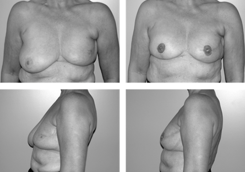 Reconstruction après chirurgie mammaire conservatrice