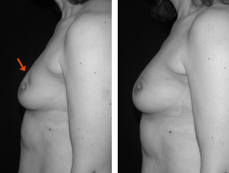 Reconstruction après chirurgie mammaire conservatrice