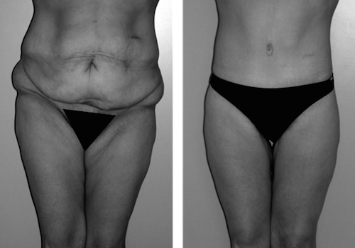 Bodylift