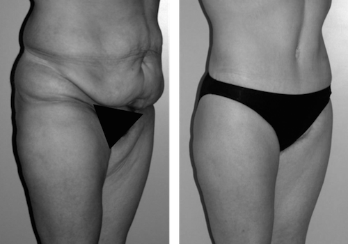 Bodylift