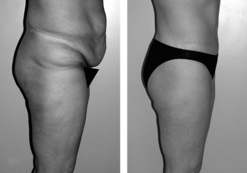 Bodylift