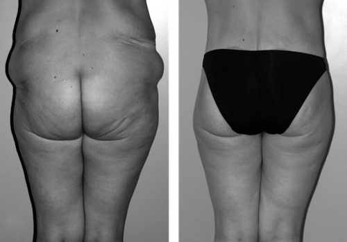 Bodylift